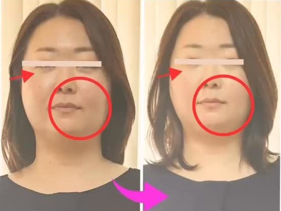 目元とほうれい線の1回のビフォーアフター